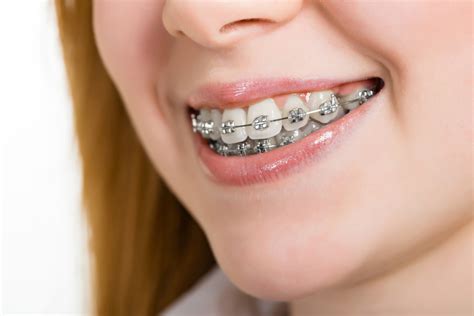 colocacion brackets metalicos|brackets dientes.